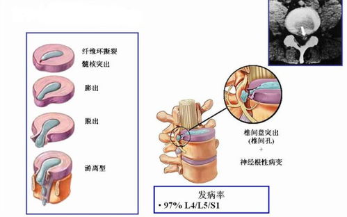 曼陀罗泡酒治腰间盘突出验方